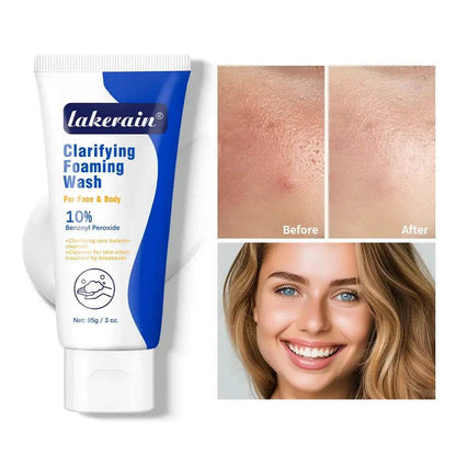 Acne Foaming Wash for Deep Cleaning, Pore Unclogging, and Redness Reduction in Facial & Body Skin Care - BON's